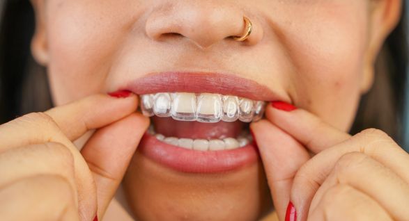 Person fitting clear Invisalign aligners, in Thunder Bay, Ontario.