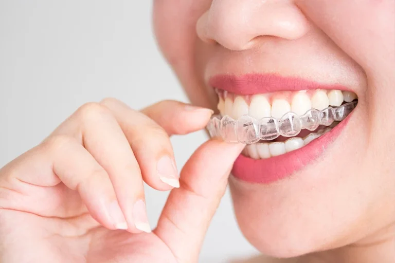 invisalign blog img