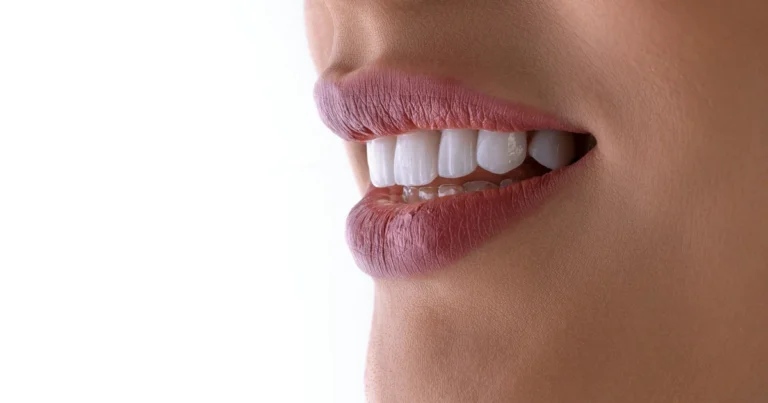 What Is Teeth Whitening and What Is the Best Way to Brighten Your Smile?